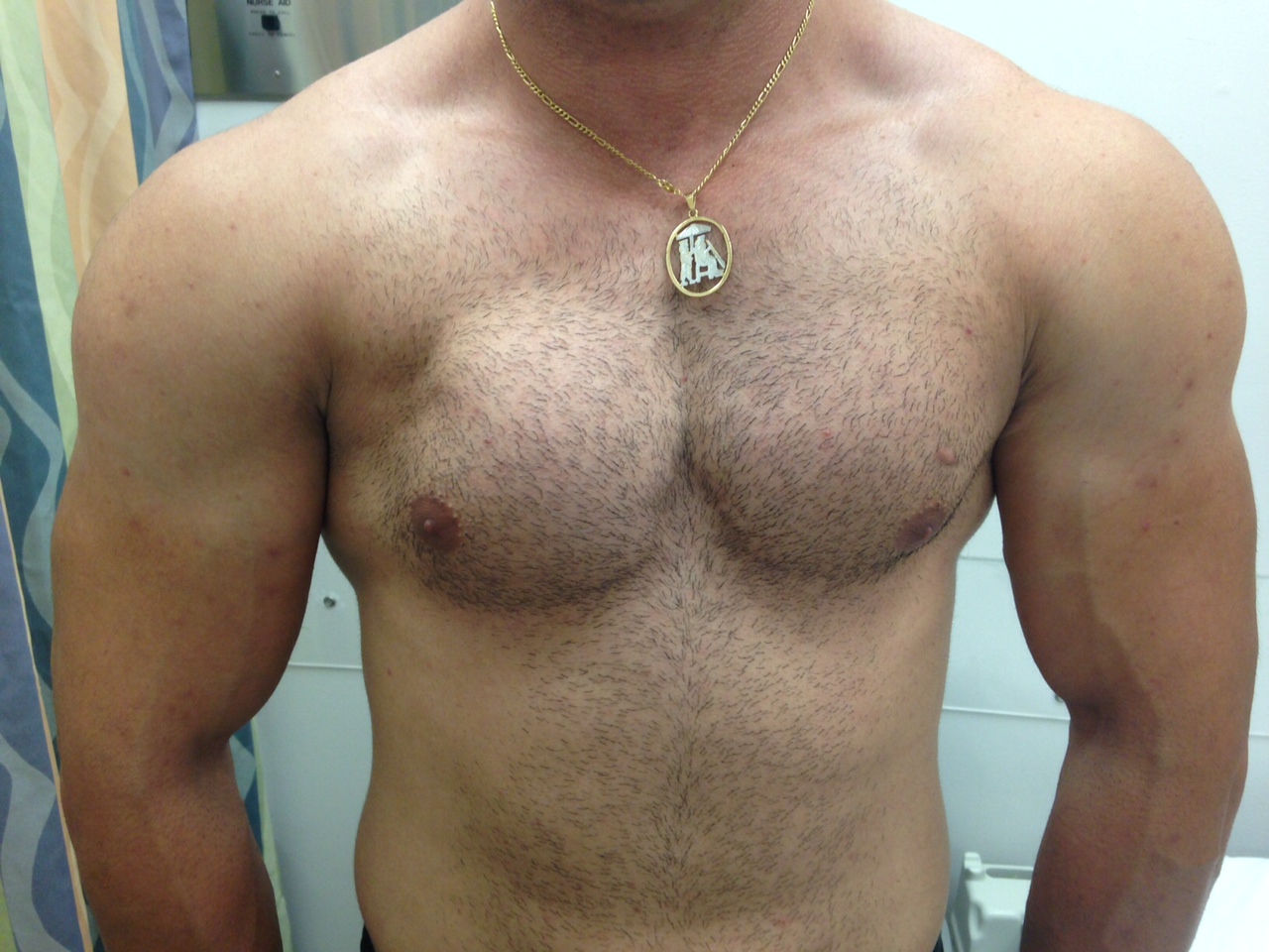 Pectoralis Tear 2